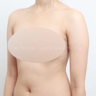 지방흡입 잘하는 병원, 어떤 기준으로? (+전후) 사진 5