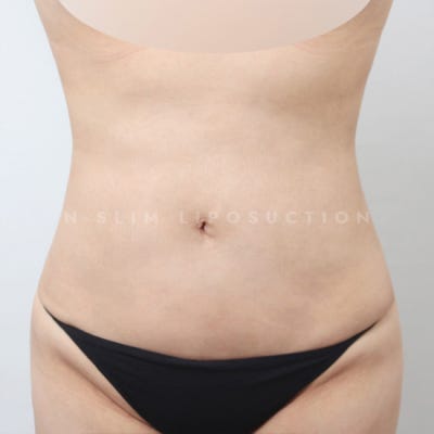 지방흡입 잘하는 병원, 어떤 기준으로? (+전후) 사진 4