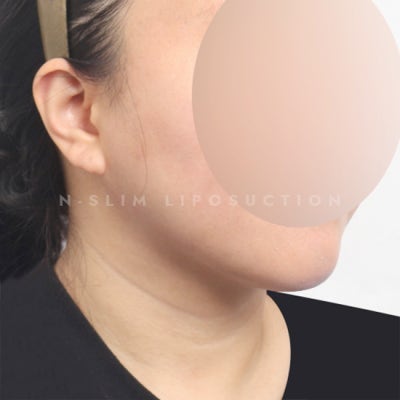 지방흡입 잘하는 병원, 어떤 기준으로? (+전후) 사진 8
