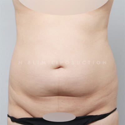 지방흡입 잘하는 병원, 어떤 기준으로? (+전후) 사진 3