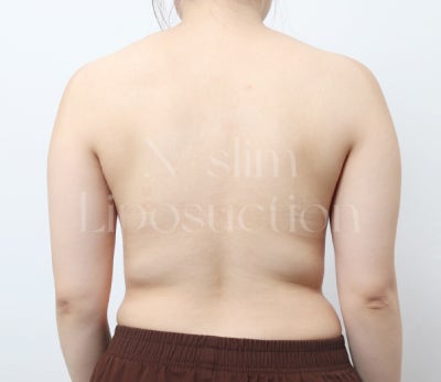 지방흡입 흡입 범위가 중요한 이유 (+부위별 전후) 사진 5