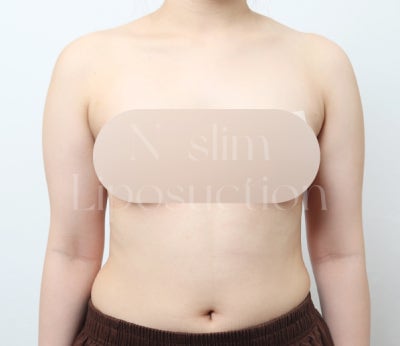 지방흡입 흡입 범위가 중요한 이유 (+부위별 전후) 사진 3