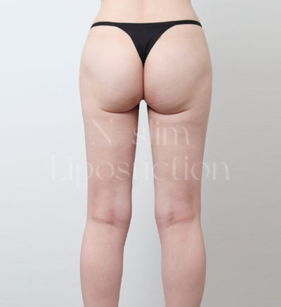지방흡입 흡입 범위가 중요한 이유 (+부위별 전후) 사진 18