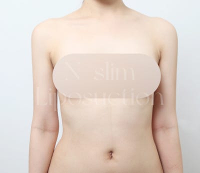 지방흡입 흡입 범위가 중요한 이유 (+부위별 전후) 사진 4