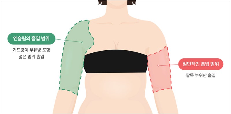 실제 사례로 보는 부위별 지방흡입 (+전후사진)