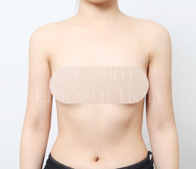 실제 사례로 보는 부위별 지방흡입 (+전후사진) 사진 2