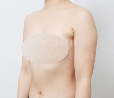실제 사례로 보는 부위별 지방흡입 (+전후사진) 사진 3
