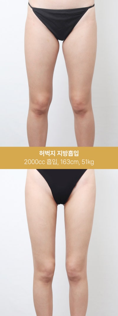 허벅지 지방흡입 실제 사례, 1600~2000cc 변화 사진 4