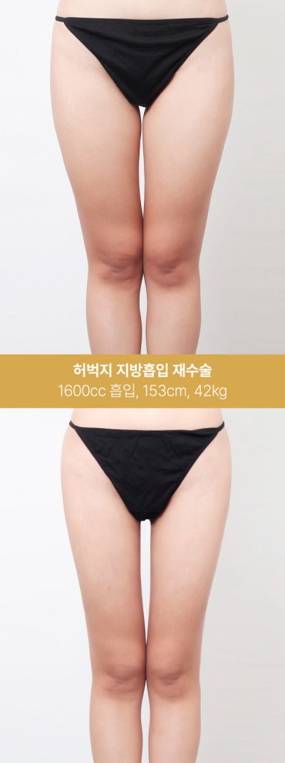 허벅지 지방흡입 실제 사례, 1600~2000cc 변화 사진 2