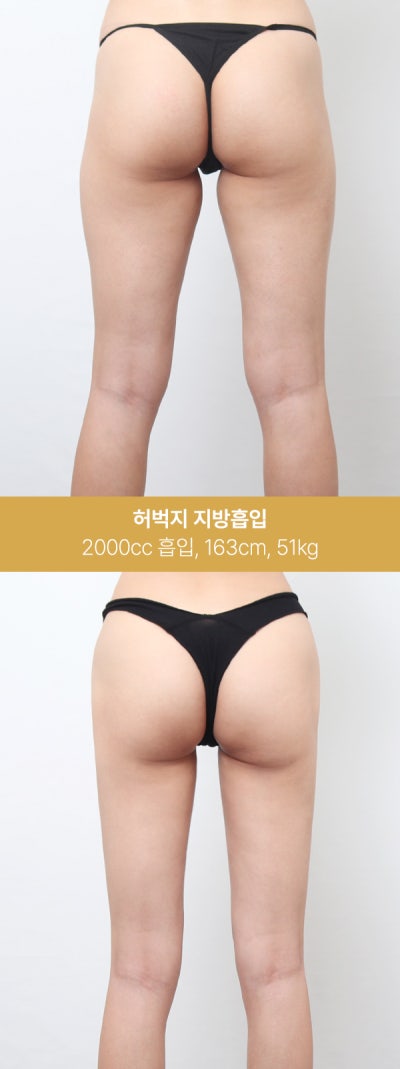 허벅지 지방흡입 실제 사례, 1600~2000cc 변화 사진 6