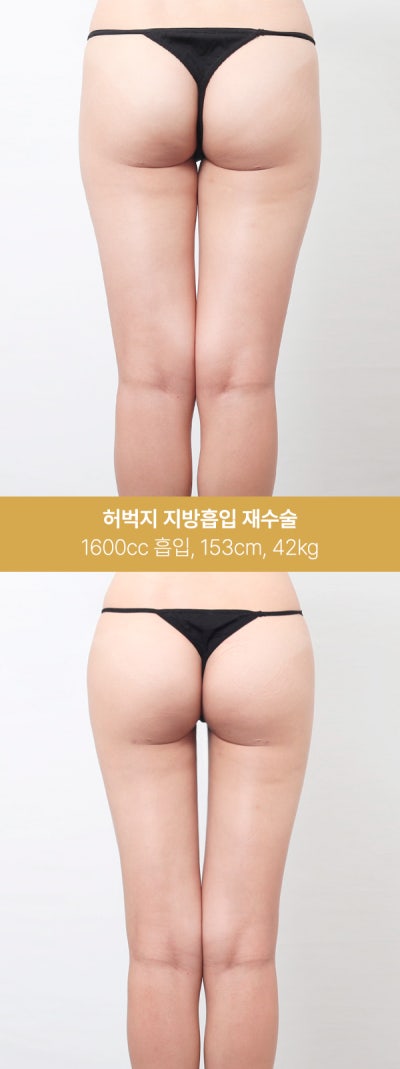 허벅지 지방흡입 실제 사례, 1600~2000cc 변화 사진 3