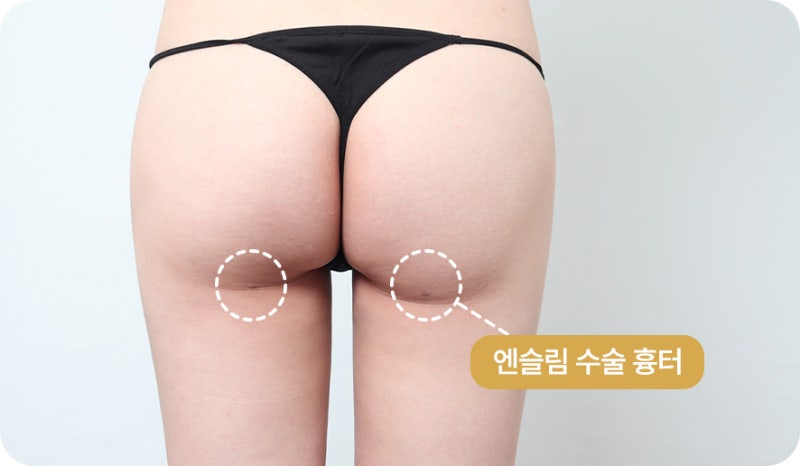허벅지 지방흡입 실제 사례, 1600~2000cc 변화