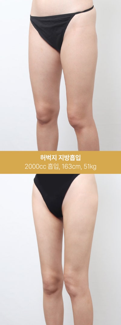허벅지 지방흡입 실제 사례, 1600~2000cc 변화 사진 5
