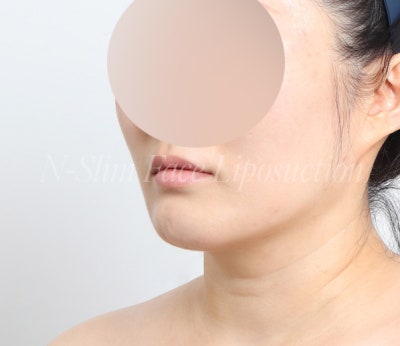 이중턱 지방흡입 50cc 실제사례, 전후 비교 사진 8