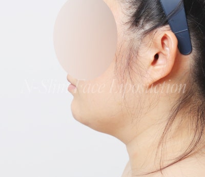 이중턱 지방흡입 50cc 실제사례, 전후 비교 사진 9
