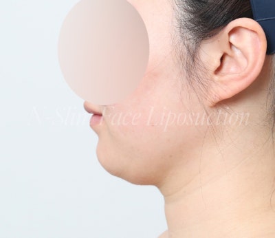 이중턱 지방흡입 50cc 실제사례, 전후 비교 사진 3