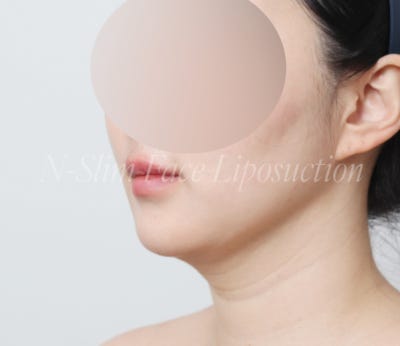 이중턱 지방흡입 50cc 실제사례, 전후 비교 사진 2