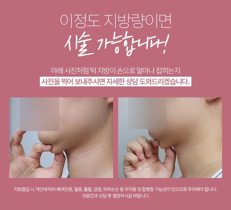 이중턱 지방흡입 50cc 실제사례, 전후 비교 사진 6
