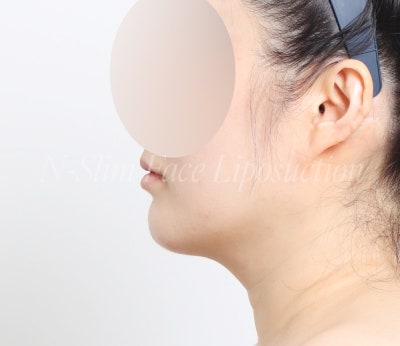 이중턱 지방흡입 50cc 실제사례, 전후 비교 사진 10