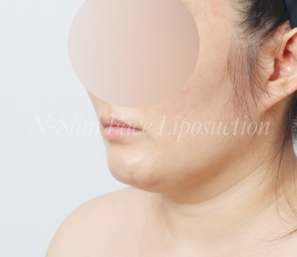 이중턱 지방흡입 50cc 실제사례, 전후사진 비교 사진 7