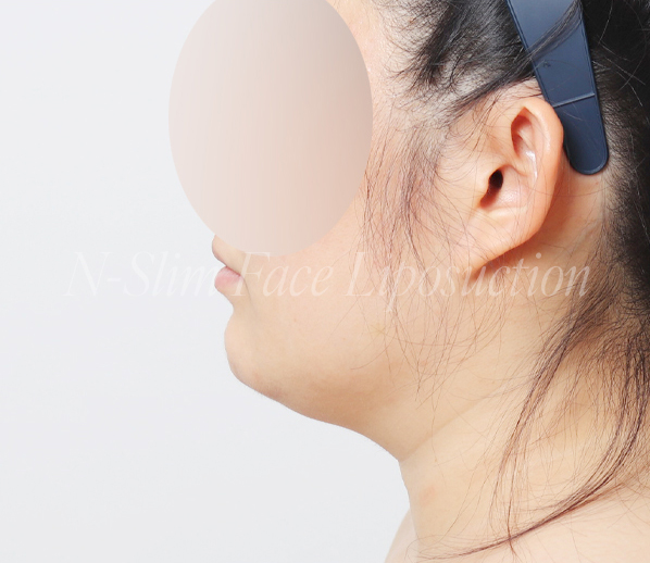 이중턱 지방흡입 50cc 실제사례, 전후사진 비교 사진 9