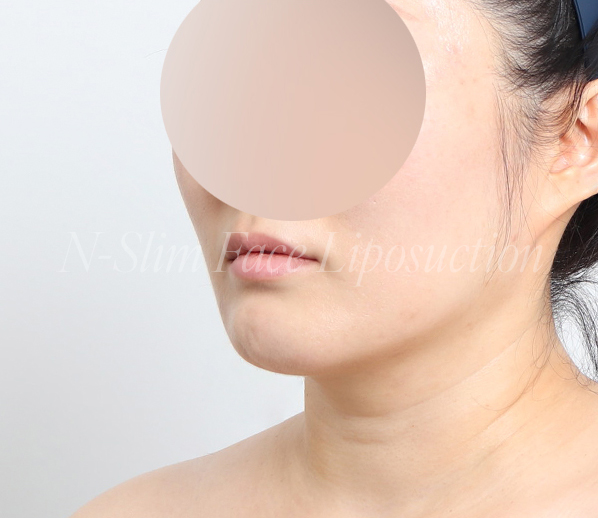 이중턱 지방흡입 50cc 실제사례, 전후사진 비교 사진 8