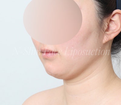 이중턱 지방흡입 50cc 실제사례, 전후사진 비교