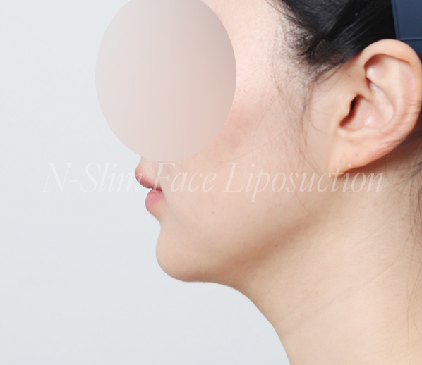 이중턱 지방흡입 50cc 실제사례, 전후사진 비교 사진 4