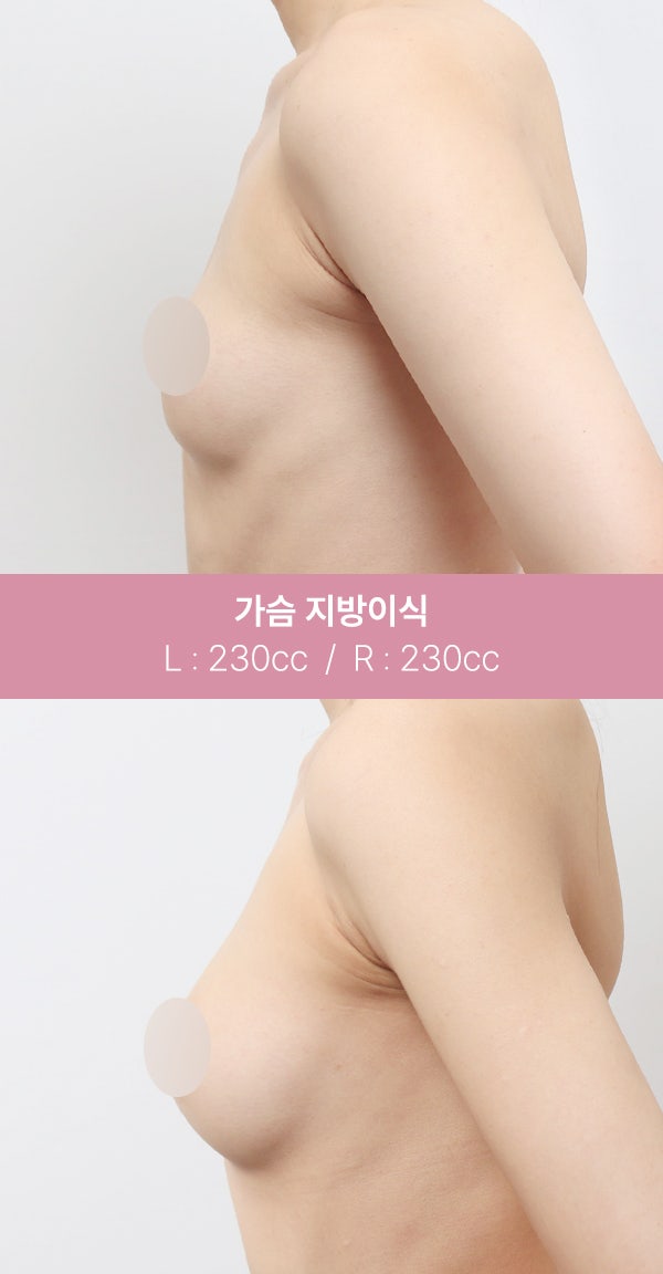 자연스러운 가슴 볼륨을 원한다면? (+실제전후) 사진 5