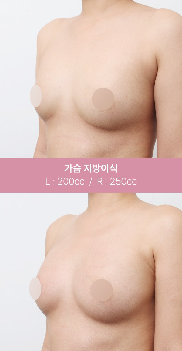 자연스러운 가슴 볼륨을 원한다면? (+실제전후) 사진 2