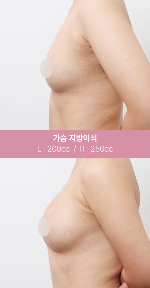 자연스러운 가슴 볼륨을 원한다면? (+실제전후) 사진 3