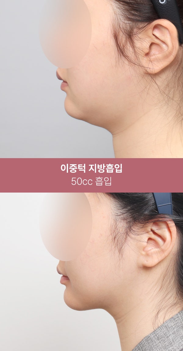 이중턱 지방흡입으로 또렷한 턱선 (+실제사례) 사진 5