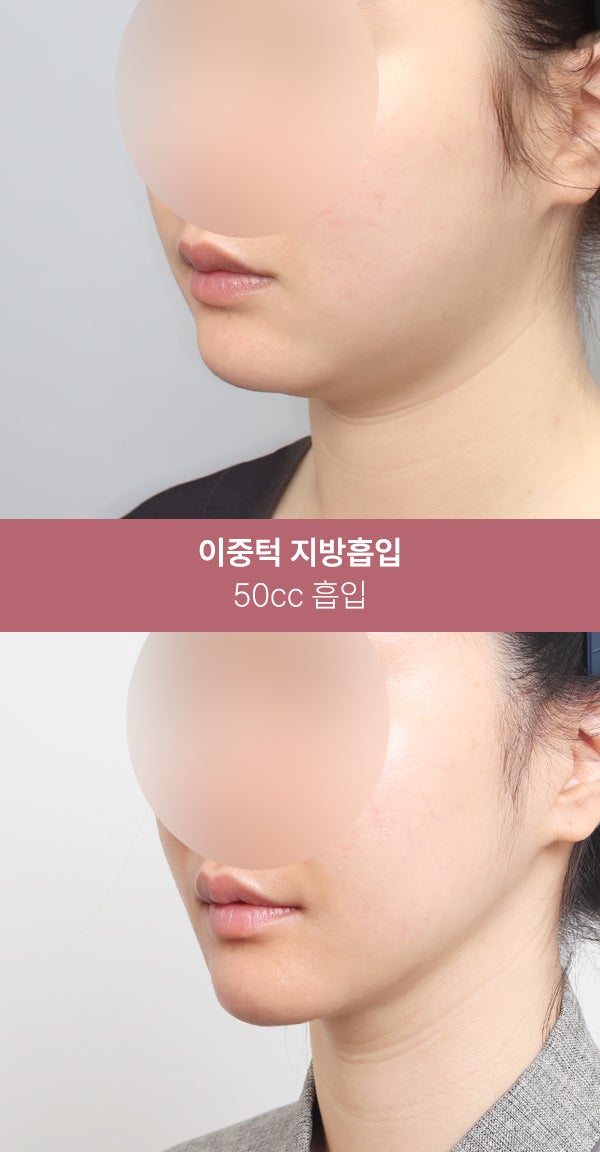 이중턱 지방흡입으로 또렷한 턱선 (+실제사례) 사진 4
