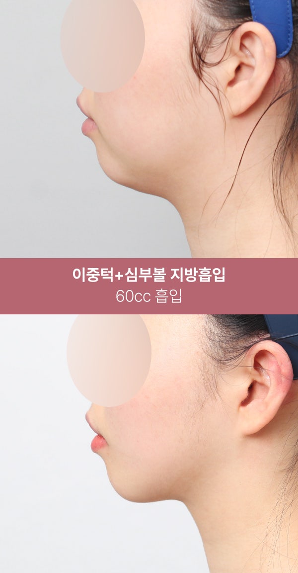 이중턱 지방흡입으로 또렷한 턱선 (+실제사례) 사진 3