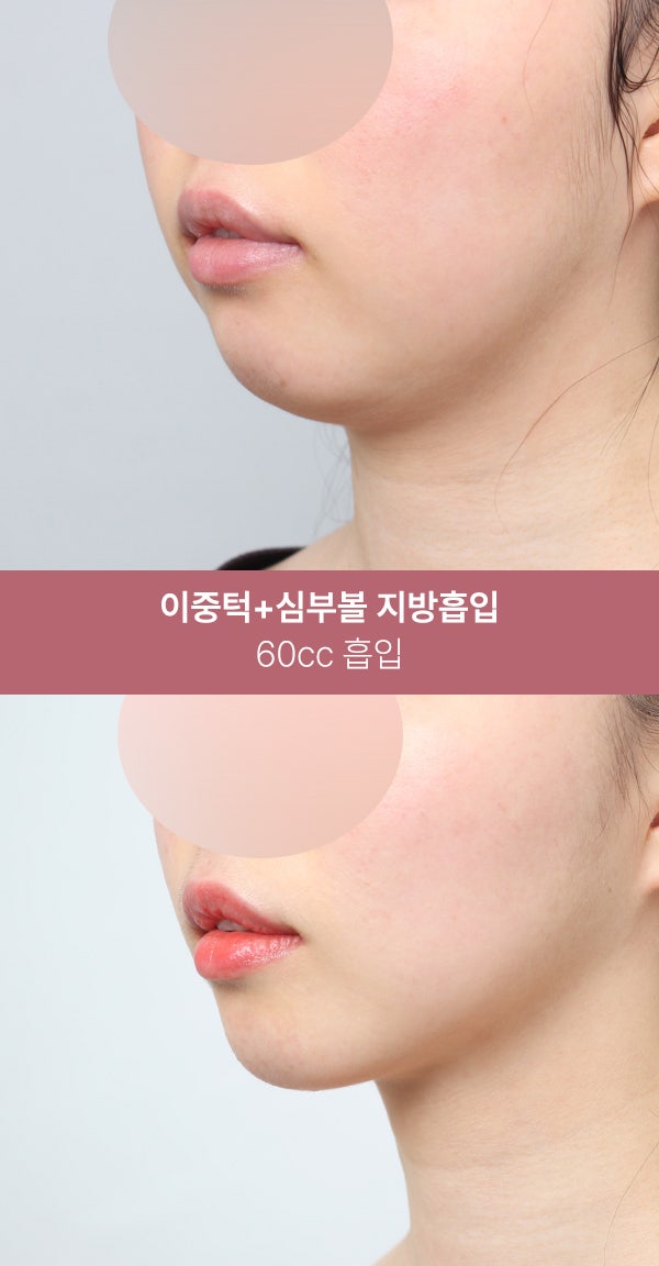이중턱 지방흡입으로 또렷한 턱선 (+실제사례) 사진 2