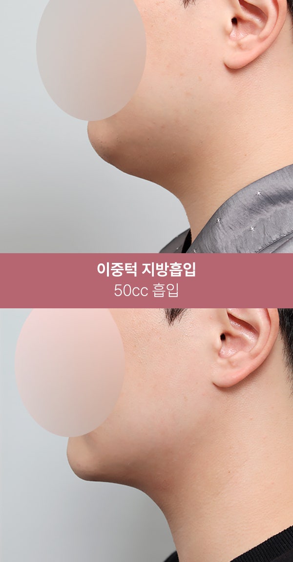 이중턱 지방흡입으로 또렷한 턱선 (+실제사례) 사진 7