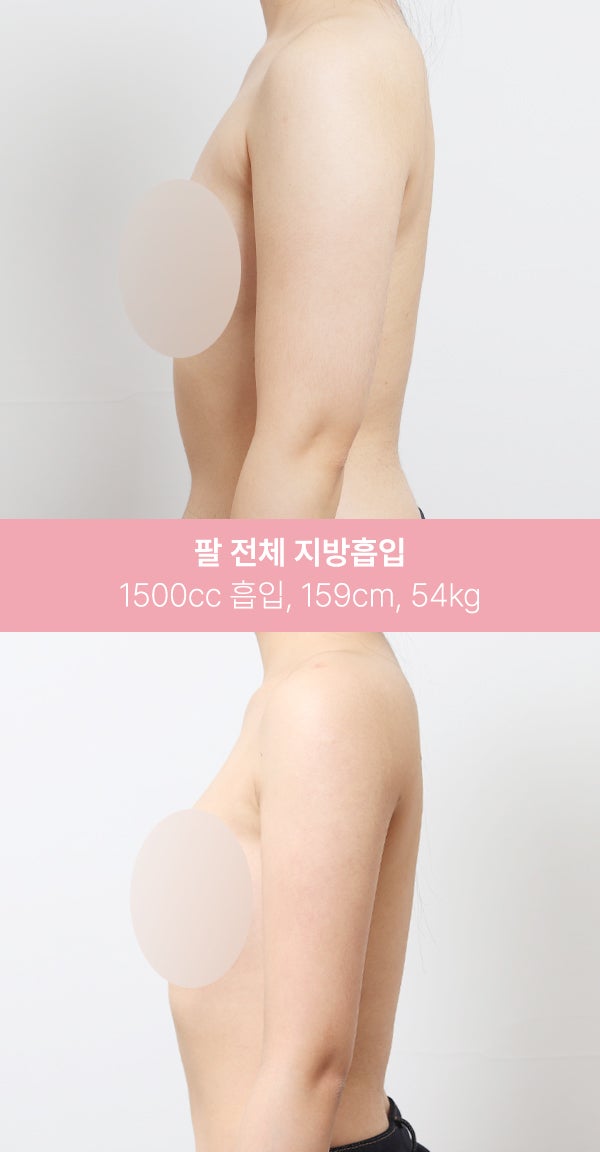 팔 전체 지방흡입 1500cc 실제 사례 사진 4
