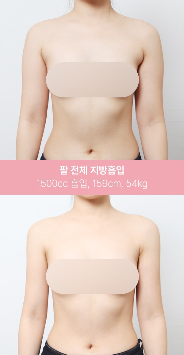 팔 전체 지방흡입 1500cc 실제 사례 사진 2