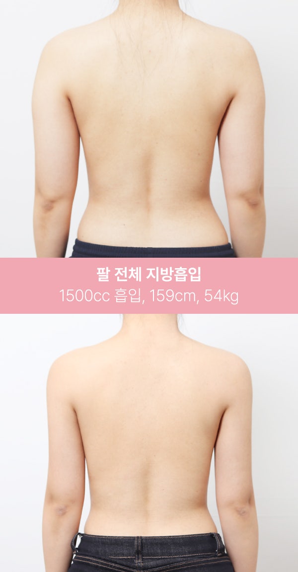 팔 전체 지방흡입 1500cc 실제 사례 사진 5