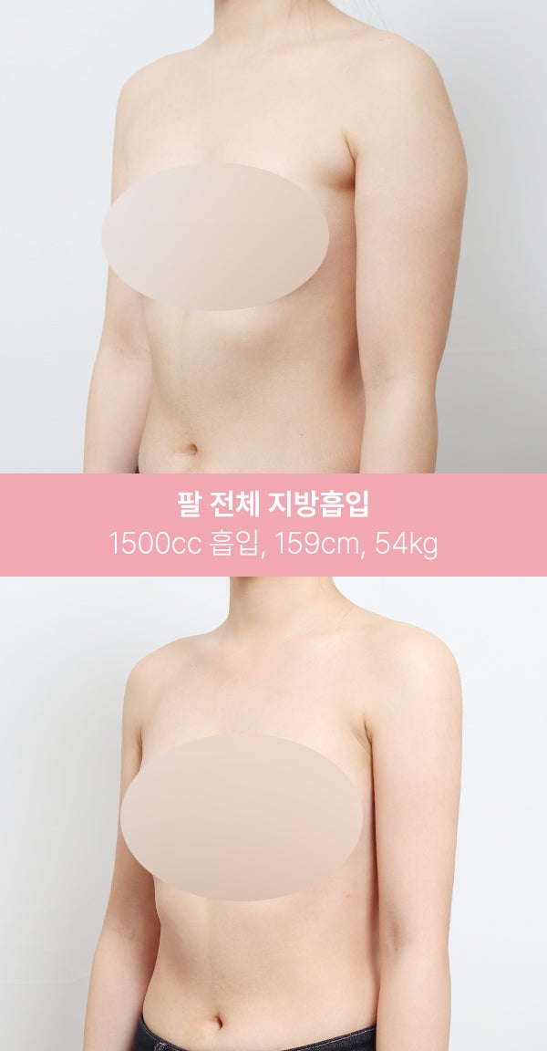 팔 전체 지방흡입 1500cc 실제 사례 사진 3