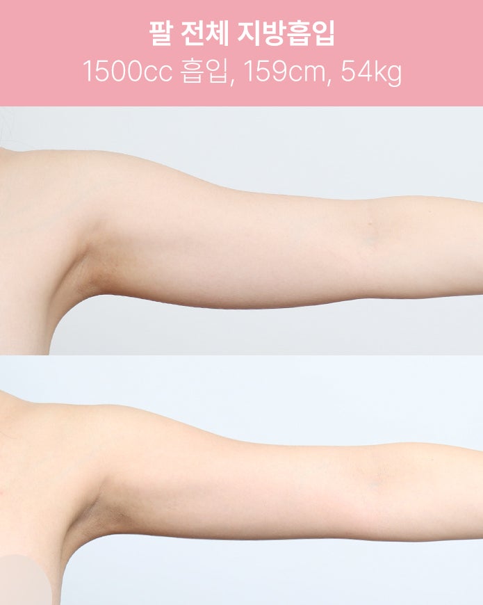 팔 전체 지방흡입 1500cc 실제 사례 사진 6