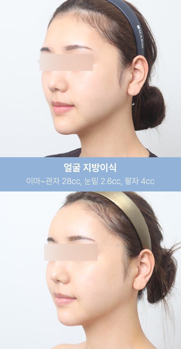 얼굴지방이식 실제 사례 (+전후사진) 사진 3