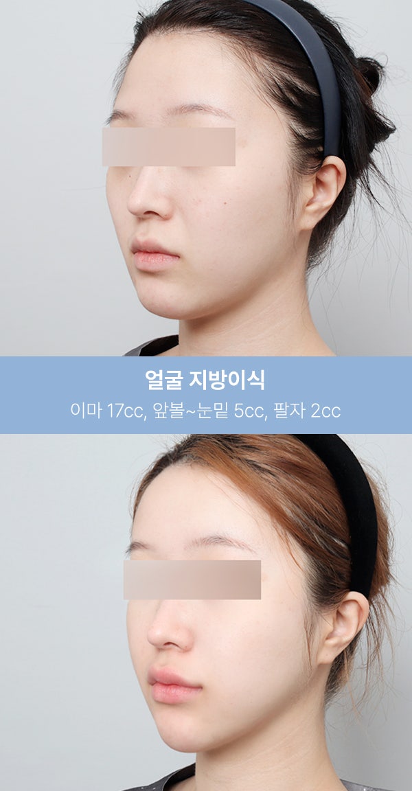 얼굴지방이식 실제 사례 (+전후사진) 사진 2