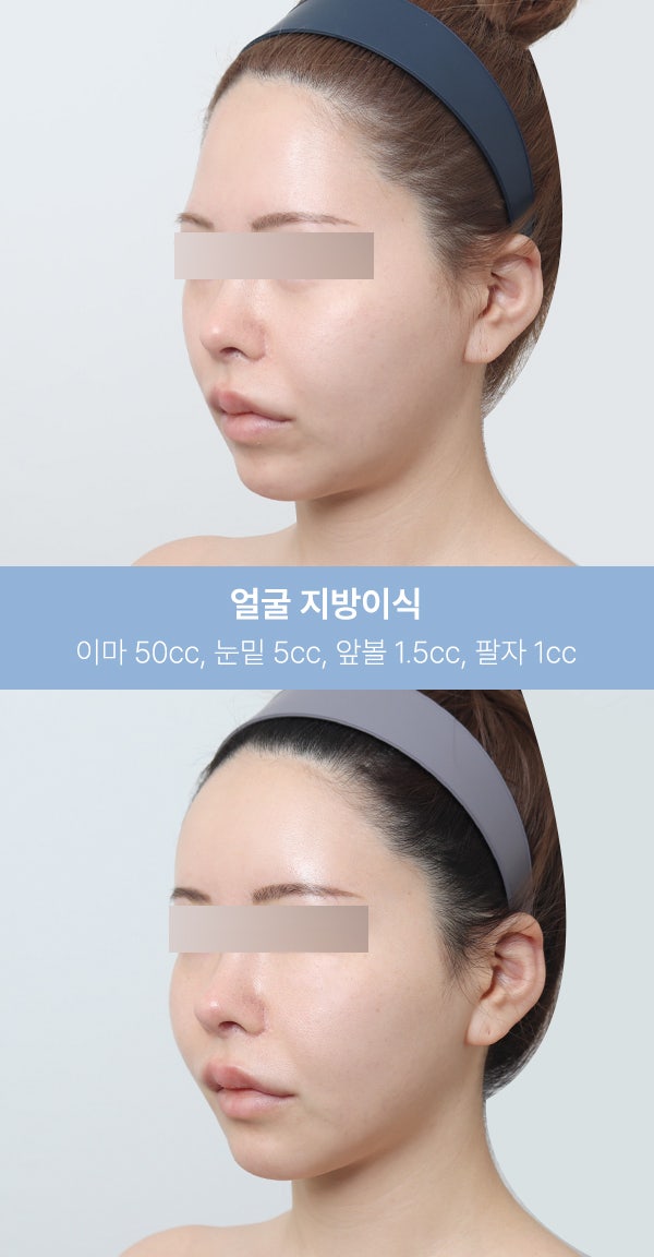 얼굴지방이식 실제 사례 (+전후사진) 사진 4