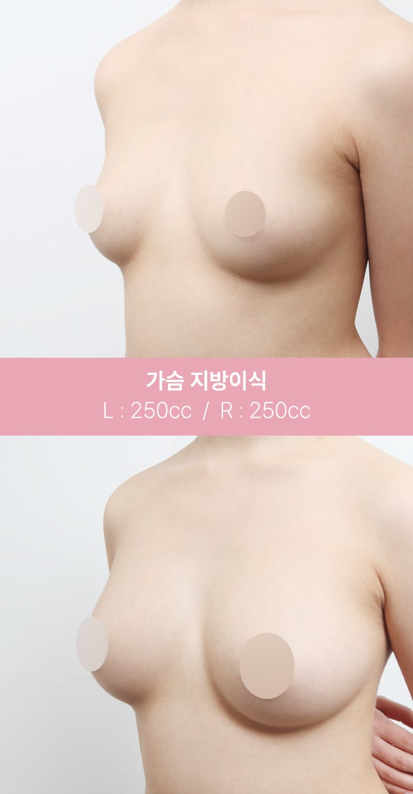가슴 지방이식, 자연스러운 볼륨 (+실제사례) 사진 2