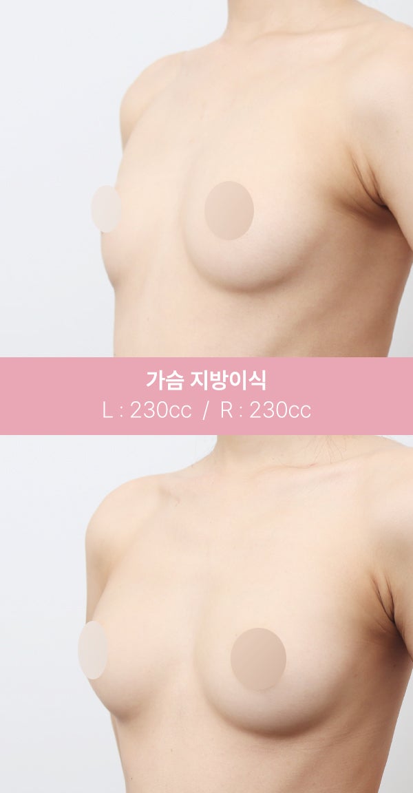 가슴 지방이식, 자연스러운 볼륨 (+실제사례) 사진 6