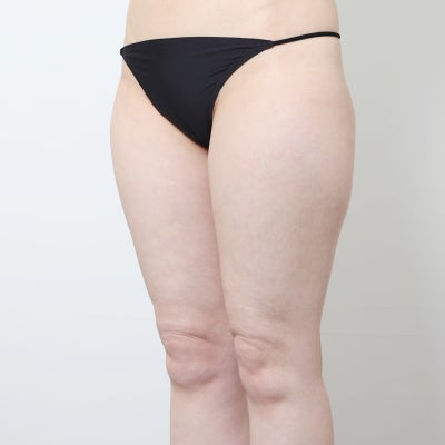 허벅지 지방흡입 중점 진료 엔슬림 (+전후) 사진 4