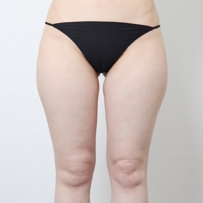 허벅지 지방흡입 중점 진료 엔슬림 (+전후) 사진 2