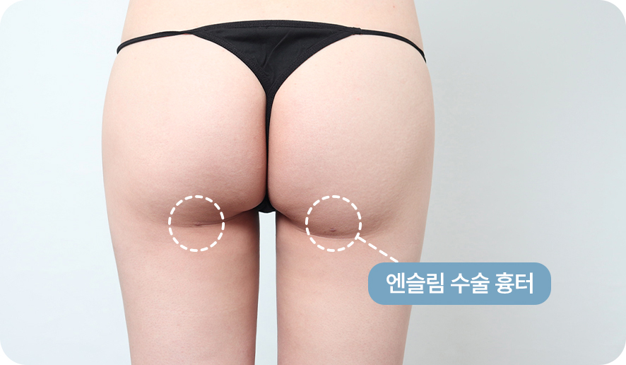 1600~2000cc 흡입 후 달라진 허벅지 라인
