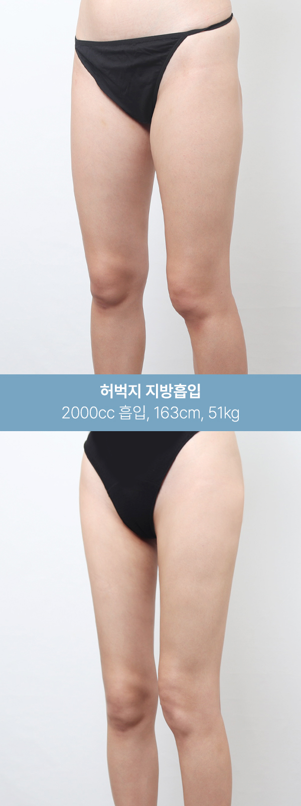 1600~2000cc 흡입 후 달라진 허벅지 라인 사진 5